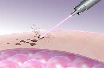 assisted laser hatching in IVF treatment